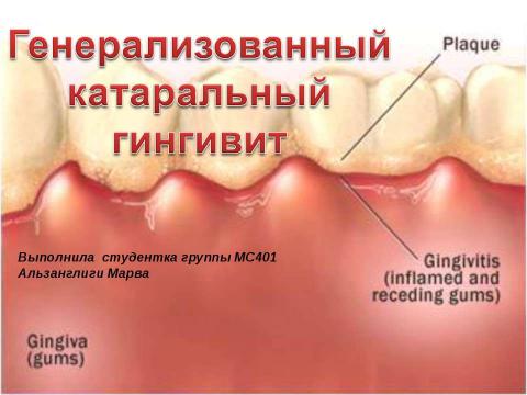 Презентация на тему "Генерализованный катаральный гингивит" по медицине