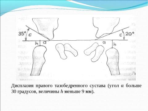 Презентация на тему "вывих у детей" по медицине