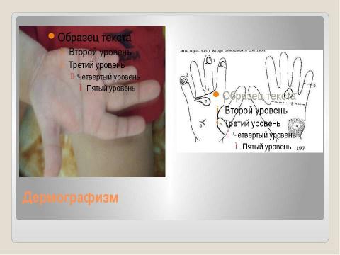 Презентация на тему "Дифференциальная диагностика и принципы лечения синдрома Корнелии Де ЛАНГЕ" по медицине