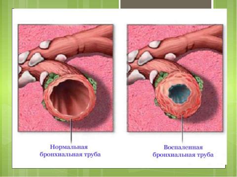 Презентация на тему "Бронхиты у детей" по медицине