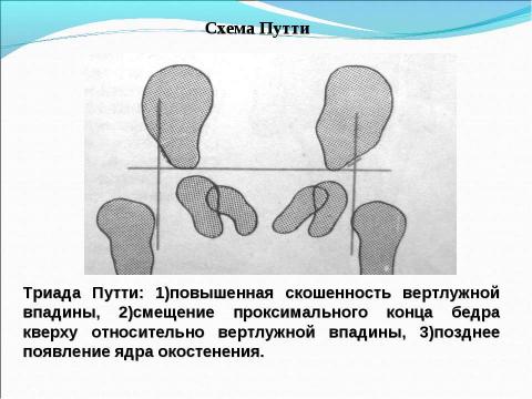 Презентация на тему "вывих у детей" по медицине