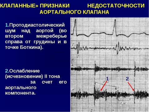 Презентация на тему "Аортальные пороки сердца" по медицине