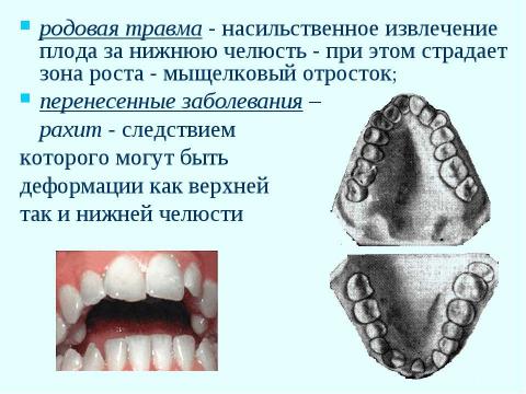 Презентация на тему "Профилактика зубочелюстных аномалий" по медицине