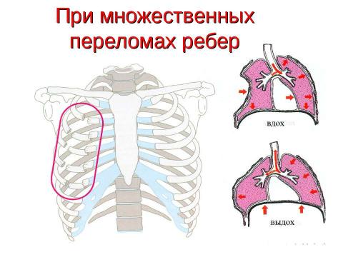 Презентация на тему "Травма груди" по ОБЖ