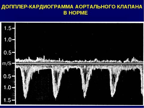 Презентация на тему "Аортальные пороки сердца" по медицине