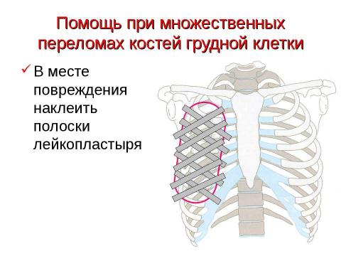 Презентация на тему "Травма груди" по ОБЖ