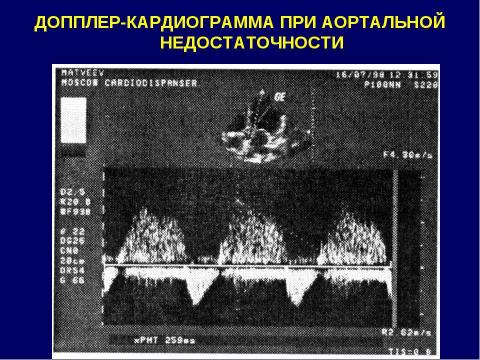 Презентация на тему "Аортальные пороки сердца" по медицине