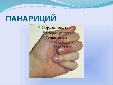 Презентация на тему "Гнойные заболевания кожи и подкожной клечатки" по медицине