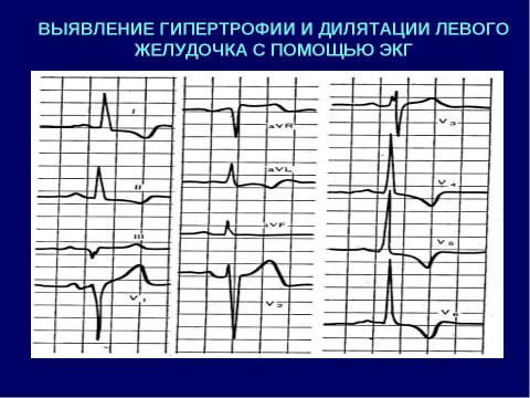 Презентация на тему "Аортальные пороки сердца" по медицине