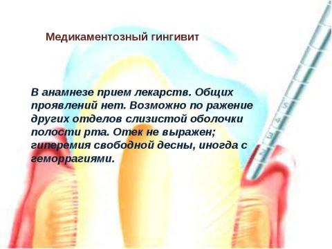 Презентация на тему "Генерализованный катаральный гингивит" по медицине