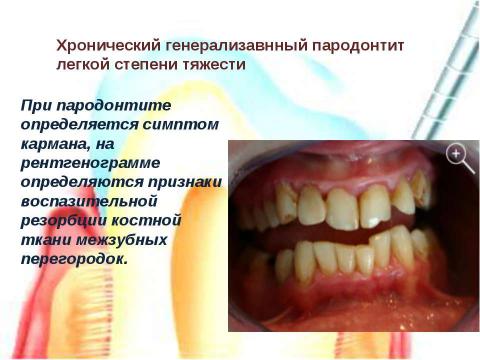 Презентация на тему "Генерализованный катаральный гингивит" по медицине