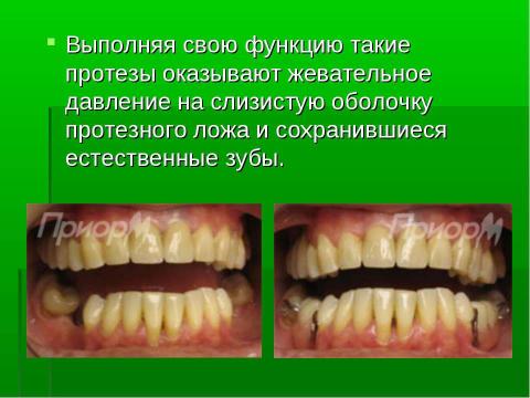 Презентация на тему "Изготовление цельнолитых съемных шин-протезов при лечении заболеваний пародонта" по медицине