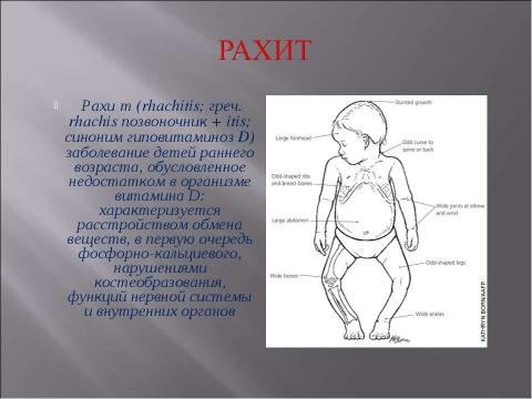 Презентация на тему "Заболевание рахит" по медицине