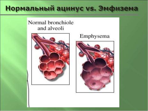 Презентация на тему "Эмфизема легких" по медицине