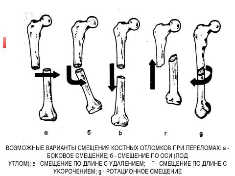 Презентация на тему "Общие вопросы хирургии повреждений Механическая травма. Вывихи. Переломы. Первая помощь, лечение" по медицине