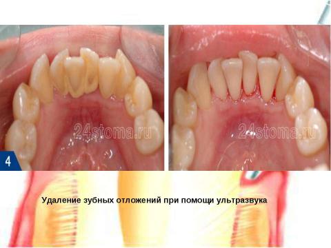 Презентация на тему "Генерализованный катаральный гингивит" по медицине