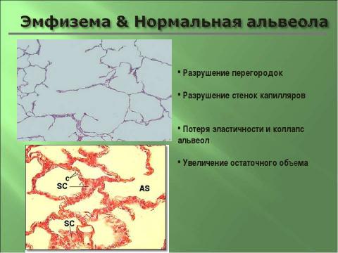 Презентация на тему "Эмфизема легких" по медицине