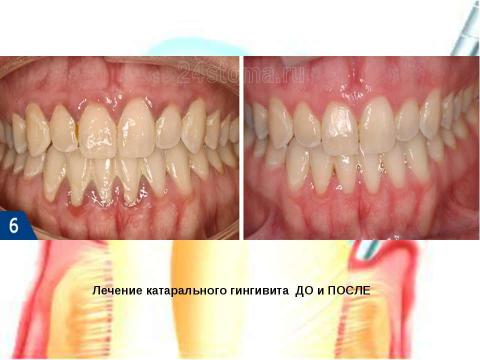 Презентация на тему "Генерализованный катаральный гингивит" по медицине