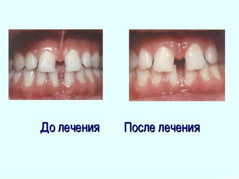 Презентация на тему "Профилактика зубочелюстных аномалий" по медицине