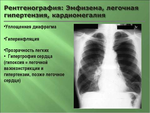 Презентация на тему "Эмфизема легких" по медицине