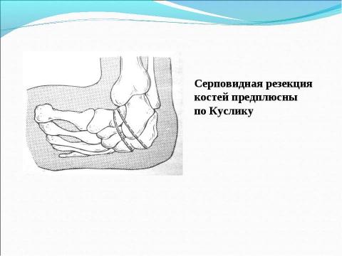 Презентация на тему "вывих у детей" по медицине