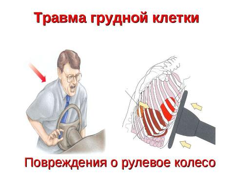 Презентация на тему "Травма груди" по ОБЖ