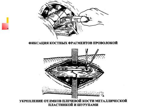 Презентация на тему "Общие вопросы хирургии повреждений Механическая травма. Вывихи. Переломы. Первая помощь, лечение" по медицине