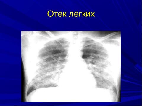 Презентация на тему "ОТЕК ЛЕГКИХ" по биологии
