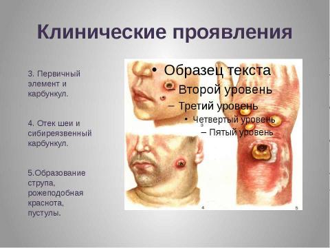 Презентация на тему "Сибирская язва" по медицине