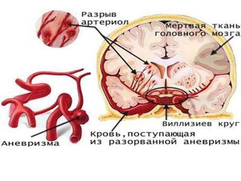 Презентация на тему "Инсульт 10 класс" по медицине