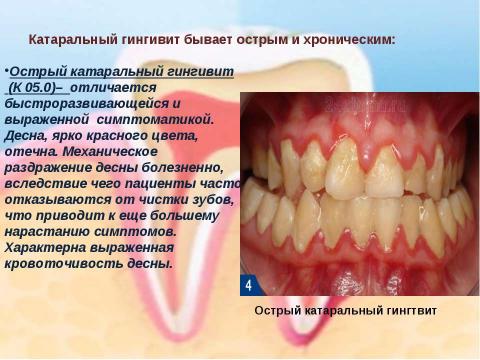 Презентация на тему "Генерализованный катаральный гингивит" по медицине