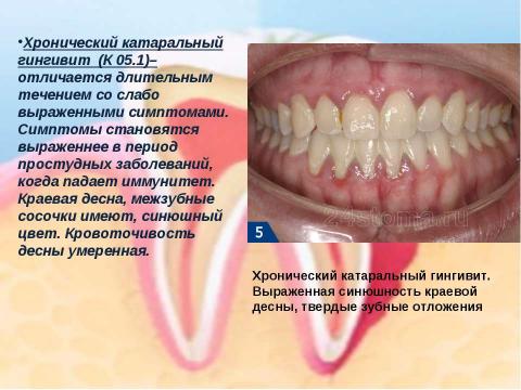 Презентация на тему "Генерализованный катаральный гингивит" по медицине