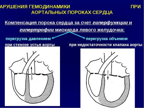 Презентация на тему "Аортальные пороки сердца" по медицине