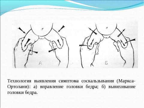 Презентация на тему "вывих у детей" по медицине