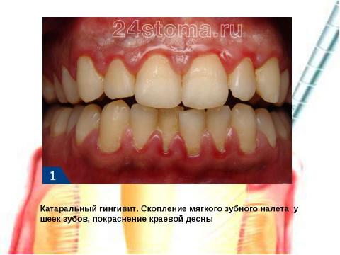 Презентация на тему "Генерализованный катаральный гингивит" по медицине