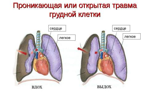 Презентация на тему "Травма груди" по ОБЖ