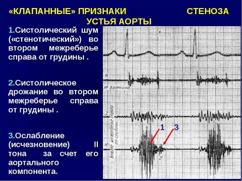 Презентация на тему "Аортальные пороки сердца" по медицине