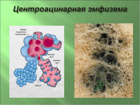 Презентация на тему "Эмфизема легких" по медицине