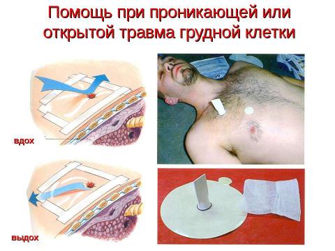 Презентация на тему "Травма груди" по ОБЖ