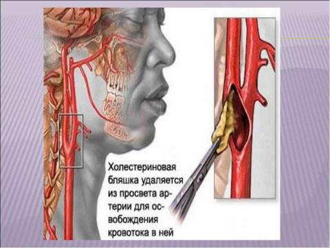 Презентация на тему "Инсульт 10 класс" по медицине