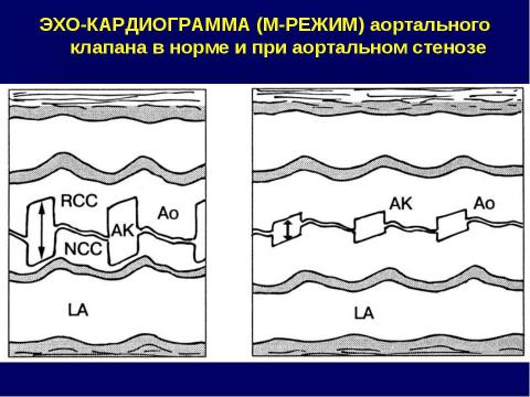 Презентация на тему "Аортальные пороки сердца" по медицине