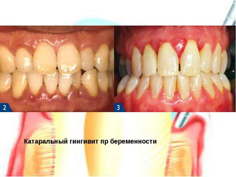 Презентация на тему "Генерализованный катаральный гингивит" по медицине